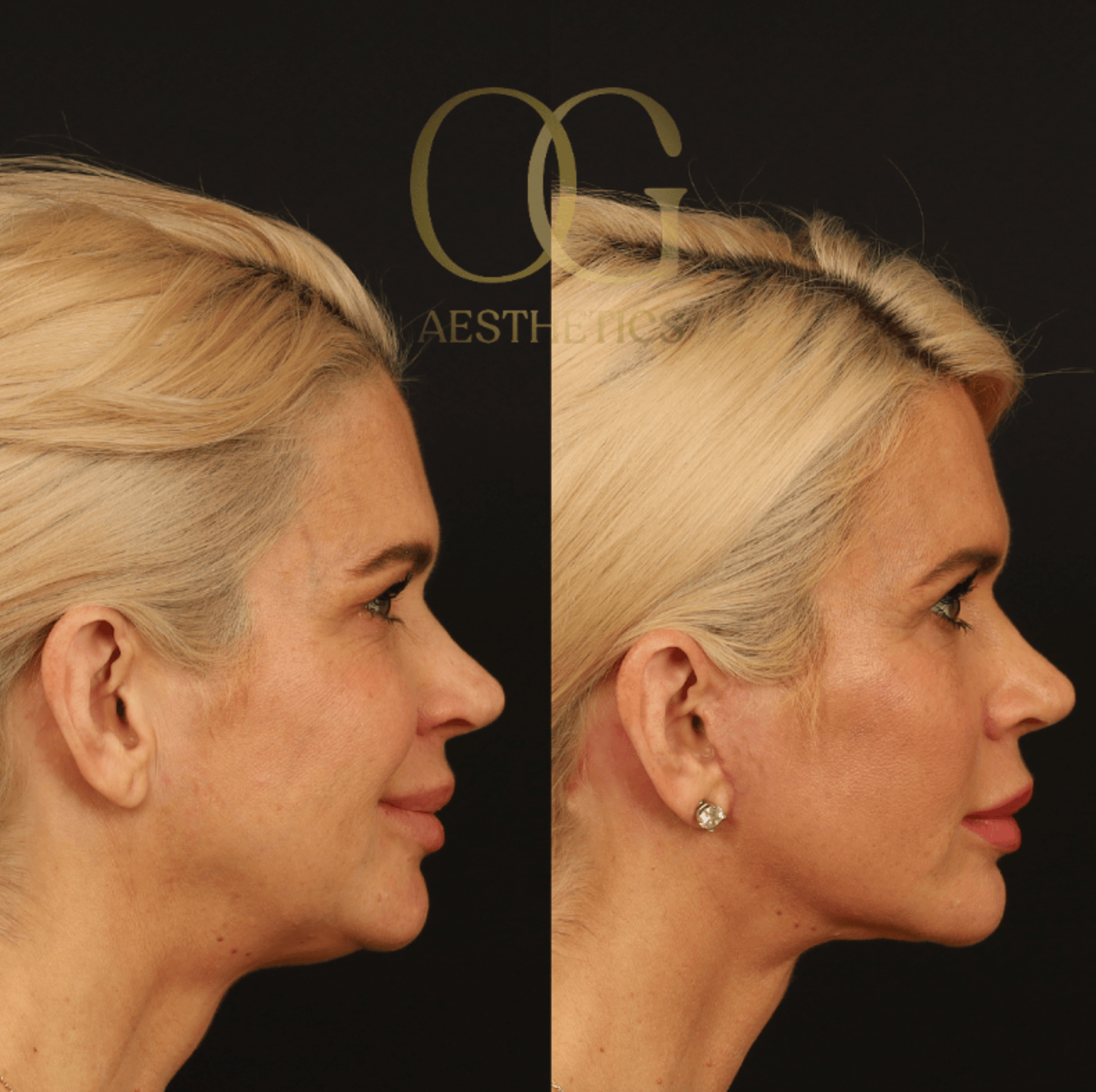 Facelift Before & After Gallery - Patient 253215 - Image 3