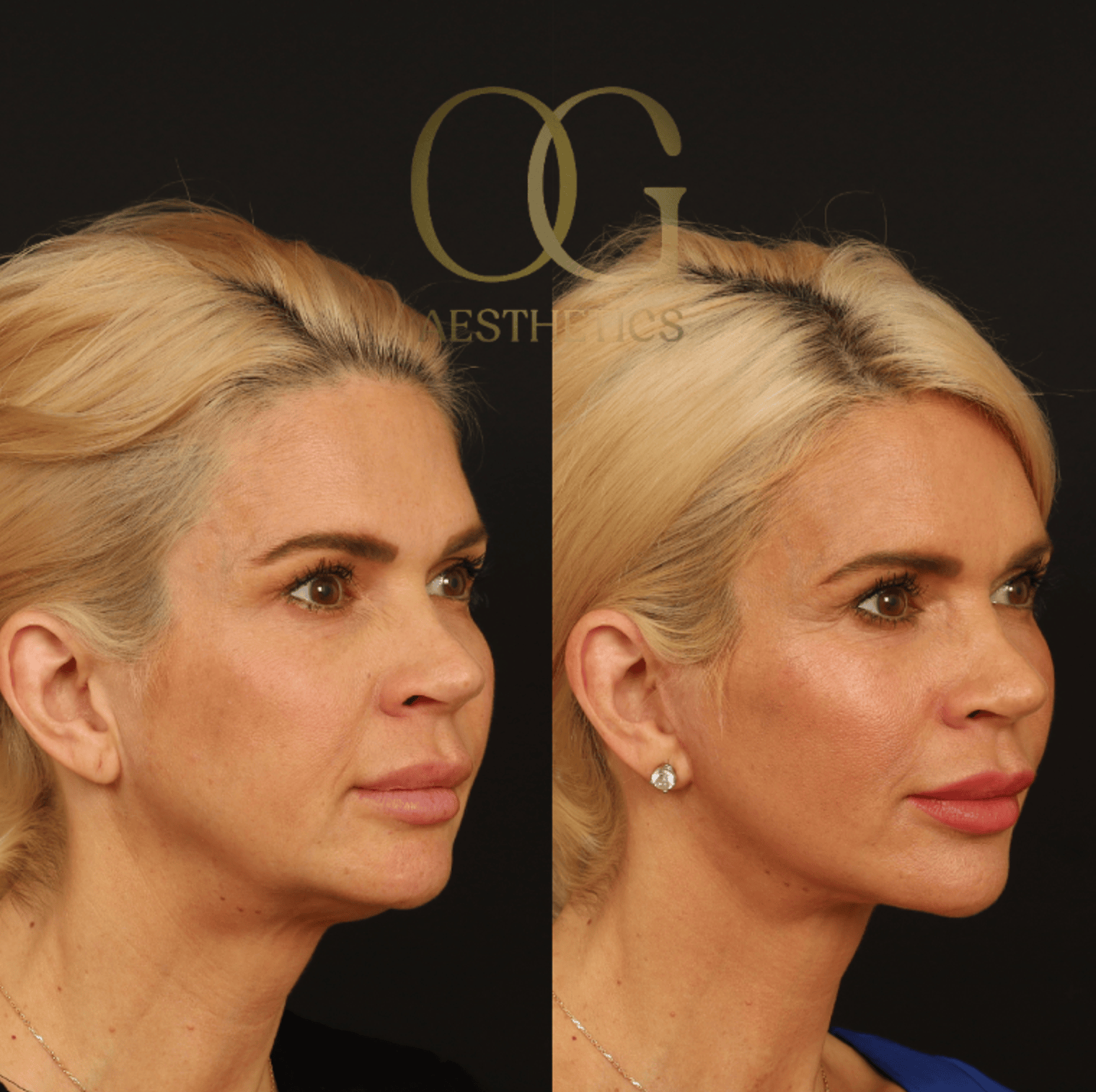 Facelift Before & After Gallery - Patient 253215 - Image 2