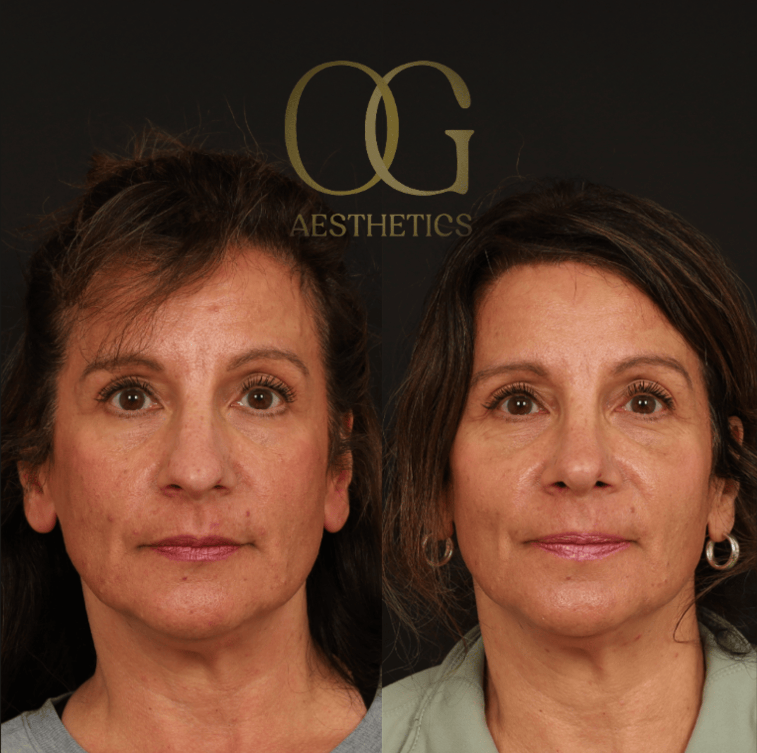 Rhinoplasty Before & After Gallery - Patient 236786 - Image 5