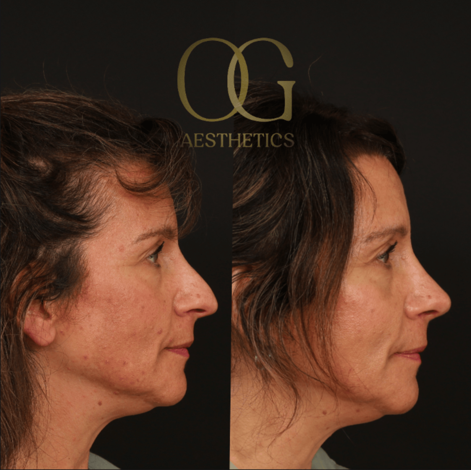 Rhinoplasty Before & After Gallery - Patient 236786 - Image 1