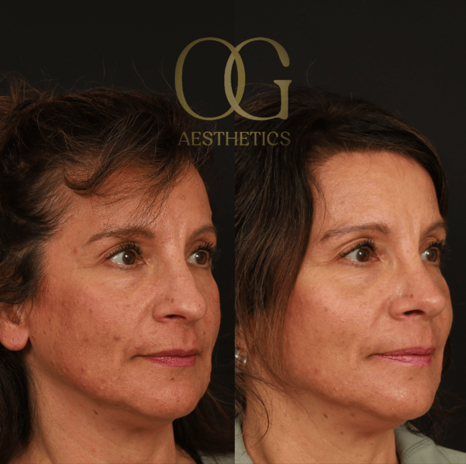 Rhinoplasty Before & After Gallery - Patient 236786 - Image 2