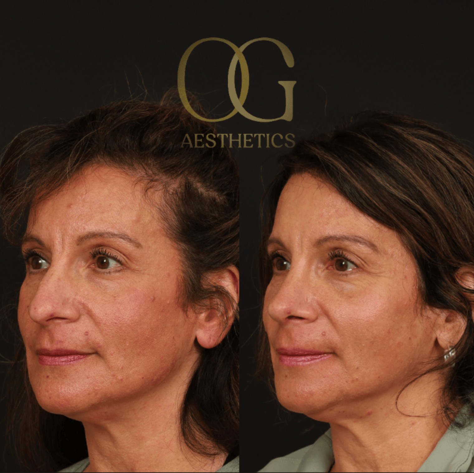 Rhinoplasty Before & After Gallery - Patient 236786 - Image 4