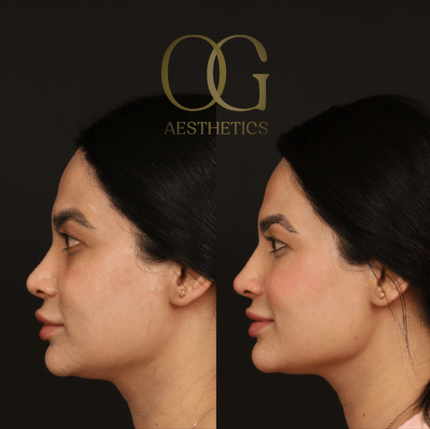 Revision Rhinoplasty Before & After Gallery - Patient 149553 - Image 4