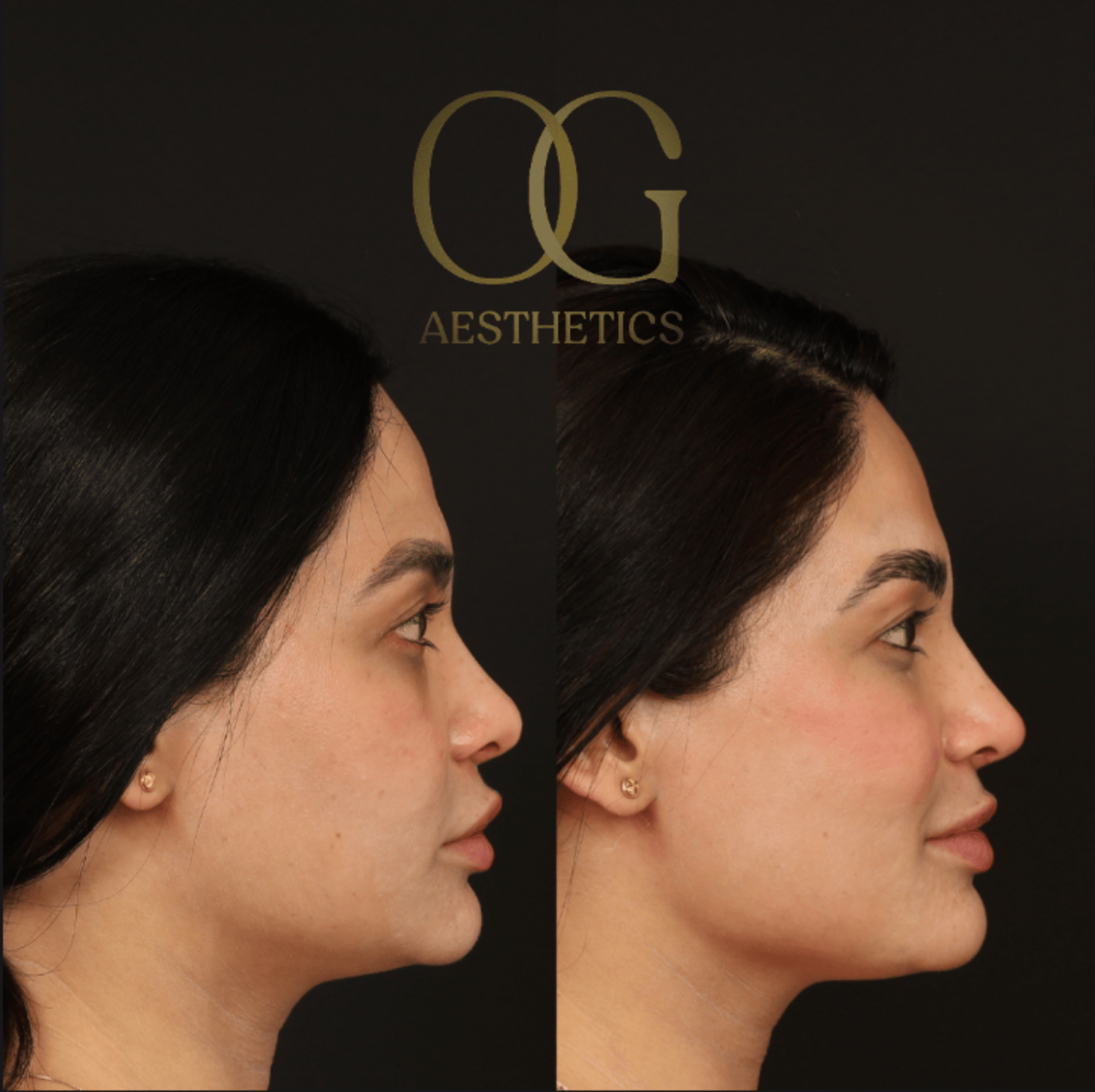 Revision Rhinoplasty Before & After Gallery - Patient 149553 - Image 1