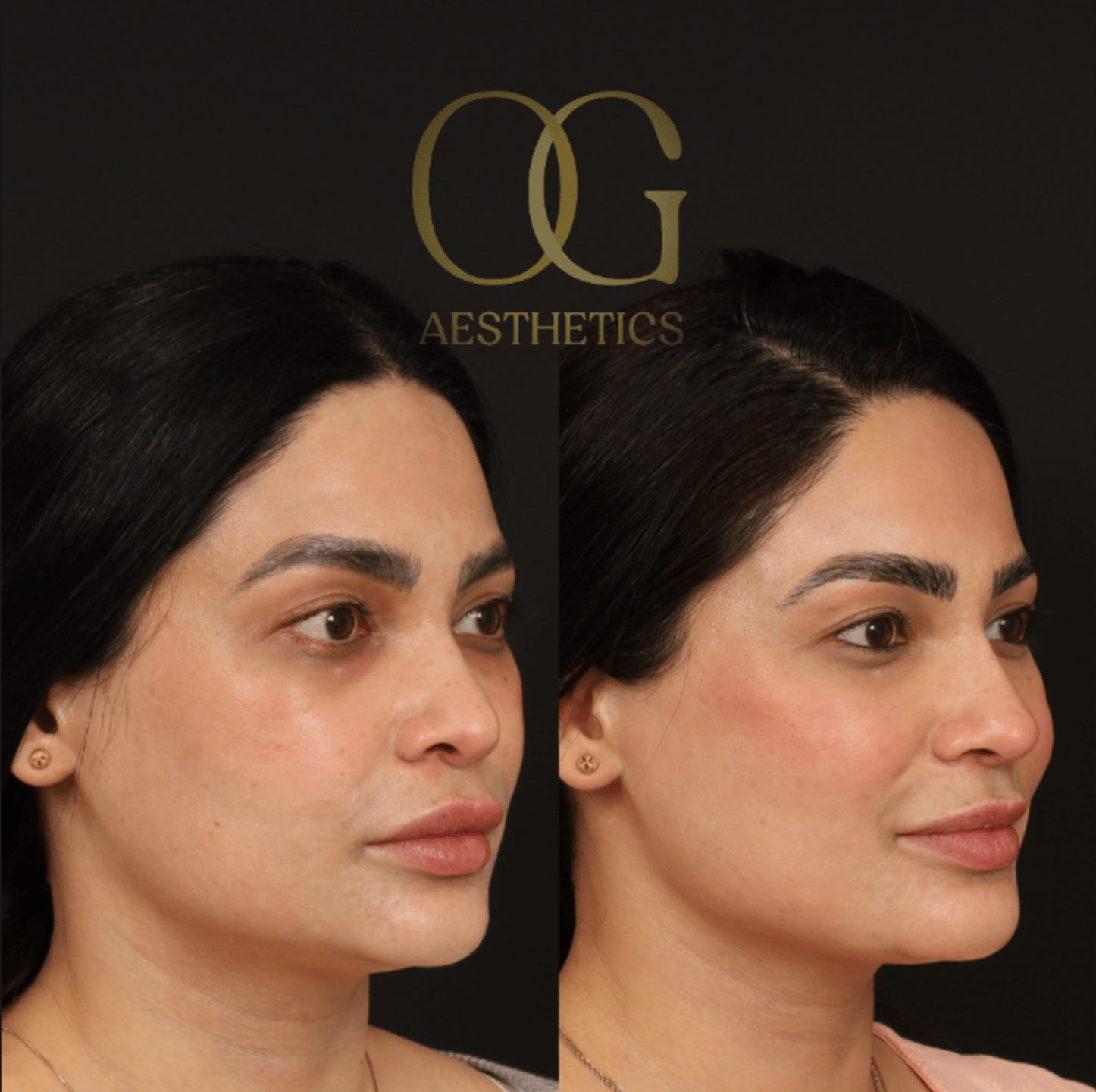 Revision Rhinoplasty Before & After Gallery - Patient 149553 - Image 2