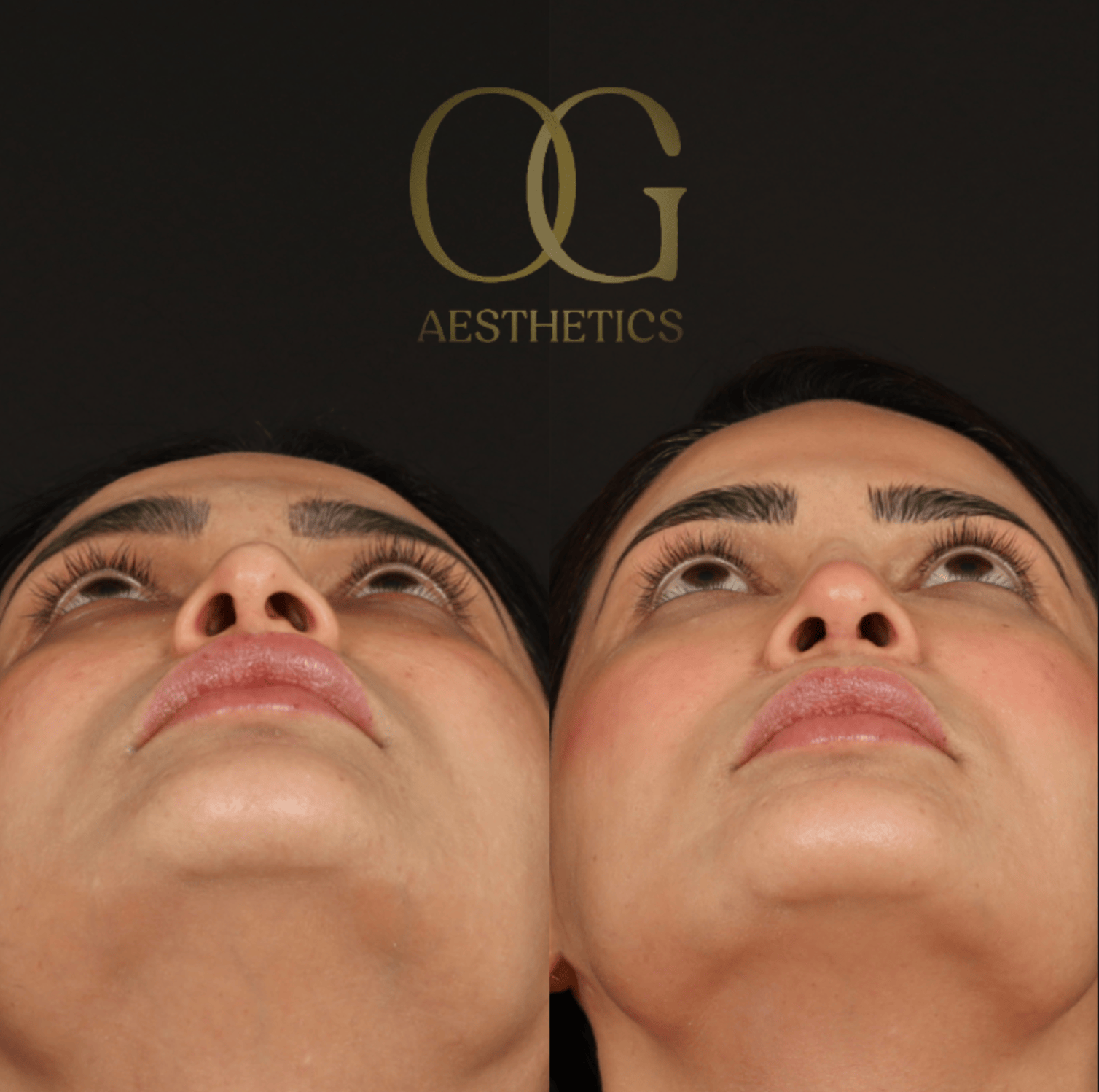 Revision Rhinoplasty Before & After Gallery - Patient 149553 - Image 6