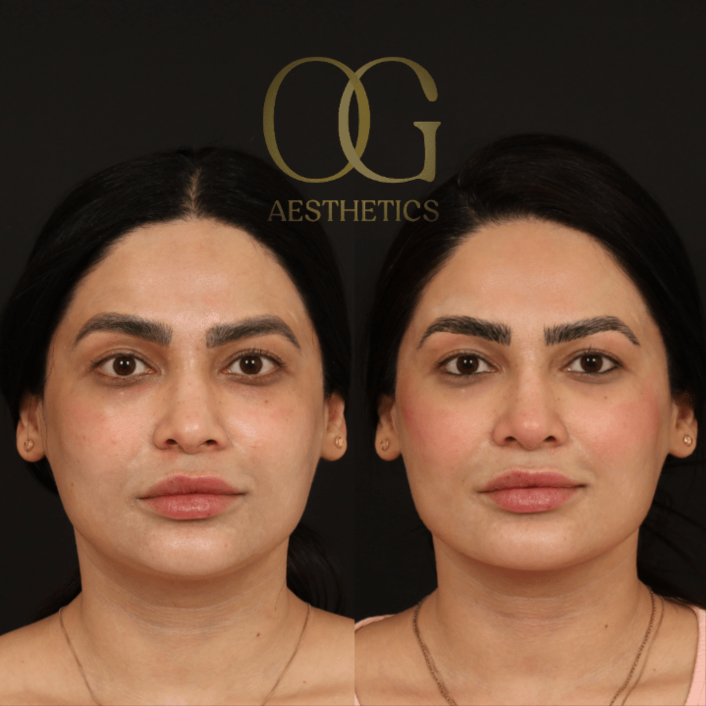 Revision Rhinoplasty Before & After Gallery - Patient 149553 - Image 5