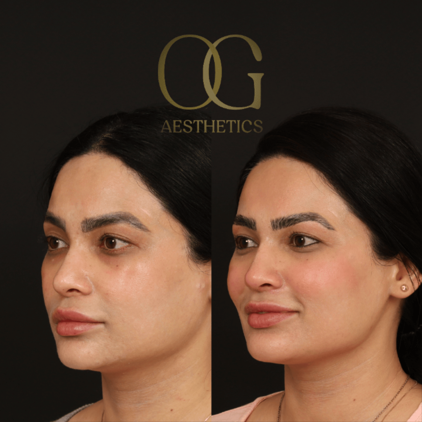 Revision Rhinoplasty Before & After Gallery - Patient 149553 - Image 3