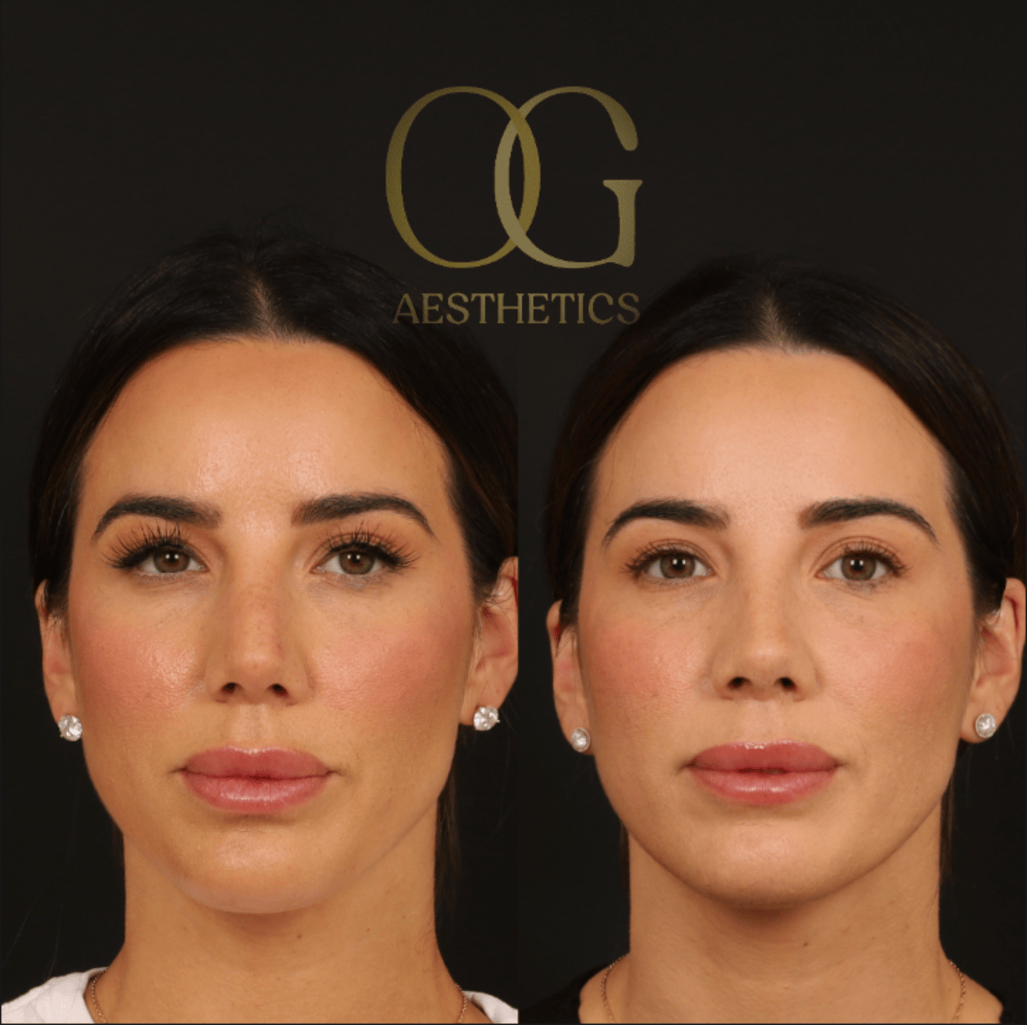 Revision Rhinoplasty Before & After Gallery - Patient 343260 - Image 5