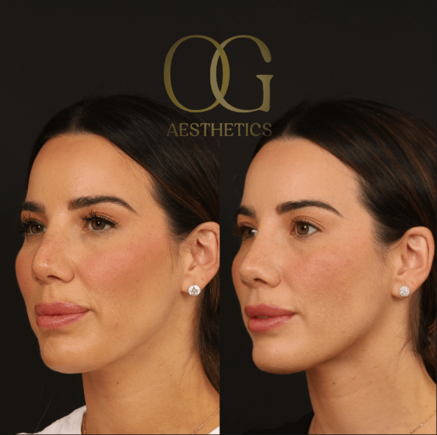Revision Rhinoplasty Before & After Gallery - Patient 343260 - Image 3