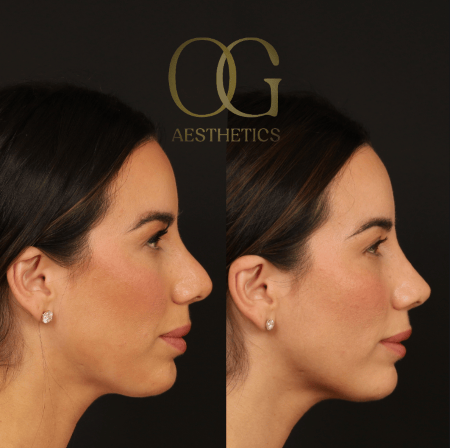 Revision Rhinoplasty Before & After Gallery - Patient 343260 - Image 1