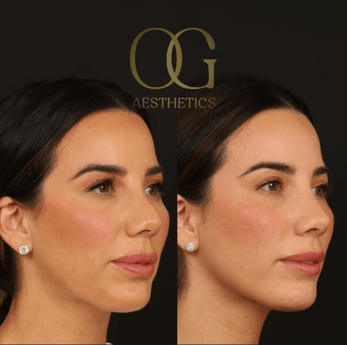 Revision Rhinoplasty Before & After Gallery - Patient 343260 - Image 2