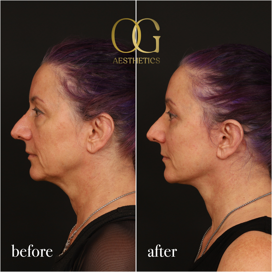 Blepharoplasty Before & After Gallery - Patient 926271 - Image 6