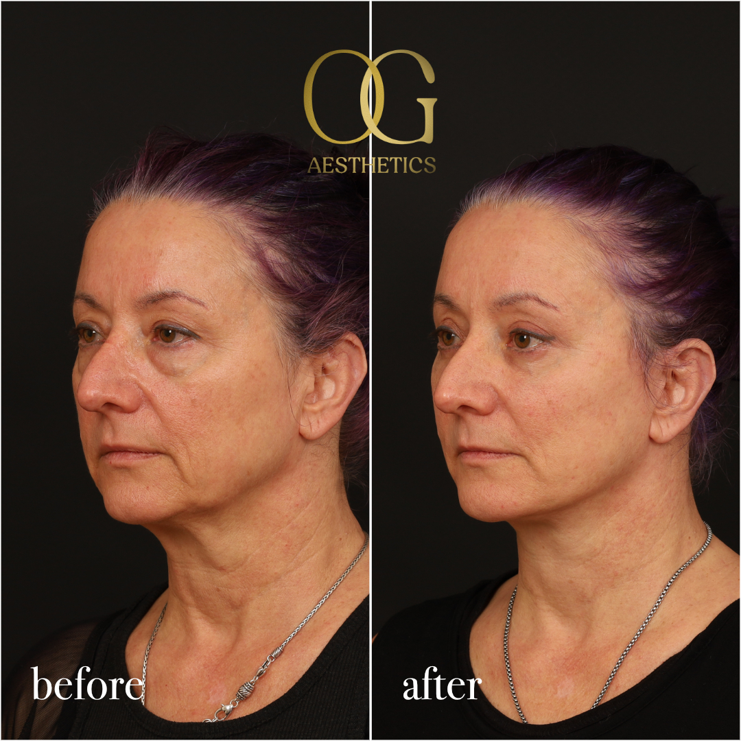 Blepharoplasty Before & After Gallery - Patient 926271 - Image 5