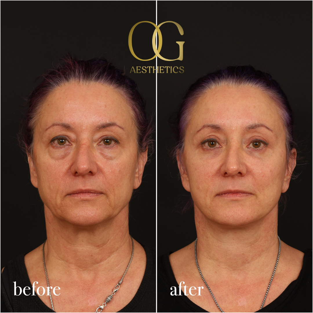 Blepharoplasty Before & After Gallery - Patient 926271 - Image 1