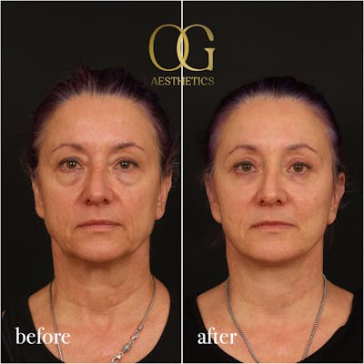 Facelift Before & After Gallery - Patient 280124 - Image 1