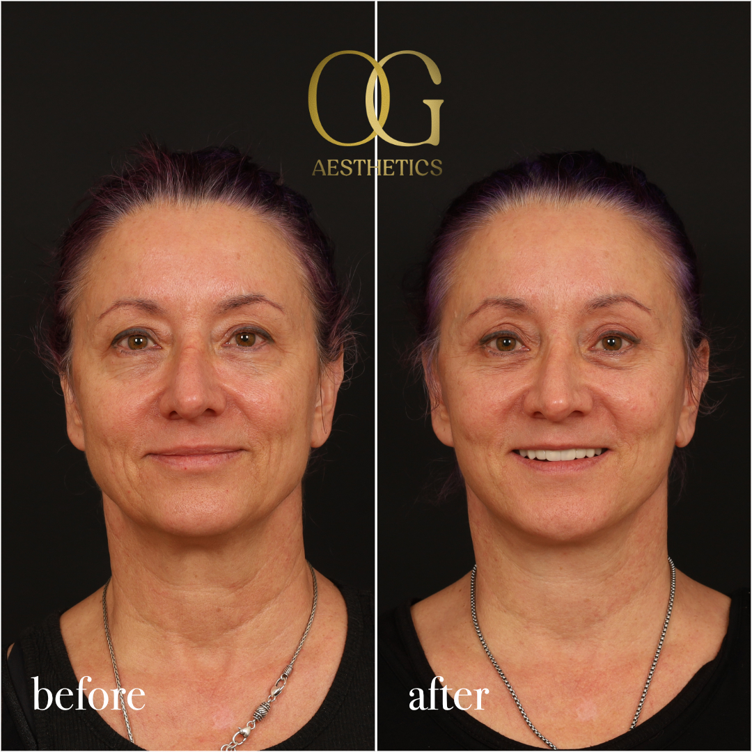 Blepharoplasty Before & After Gallery - Patient 926271 - Image 2