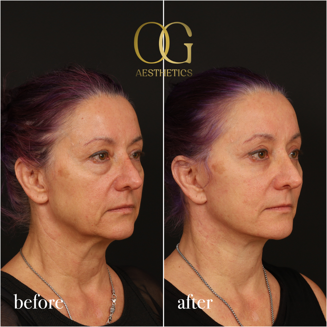 Blepharoplasty Before & After Gallery - Patient 926271 - Image 3