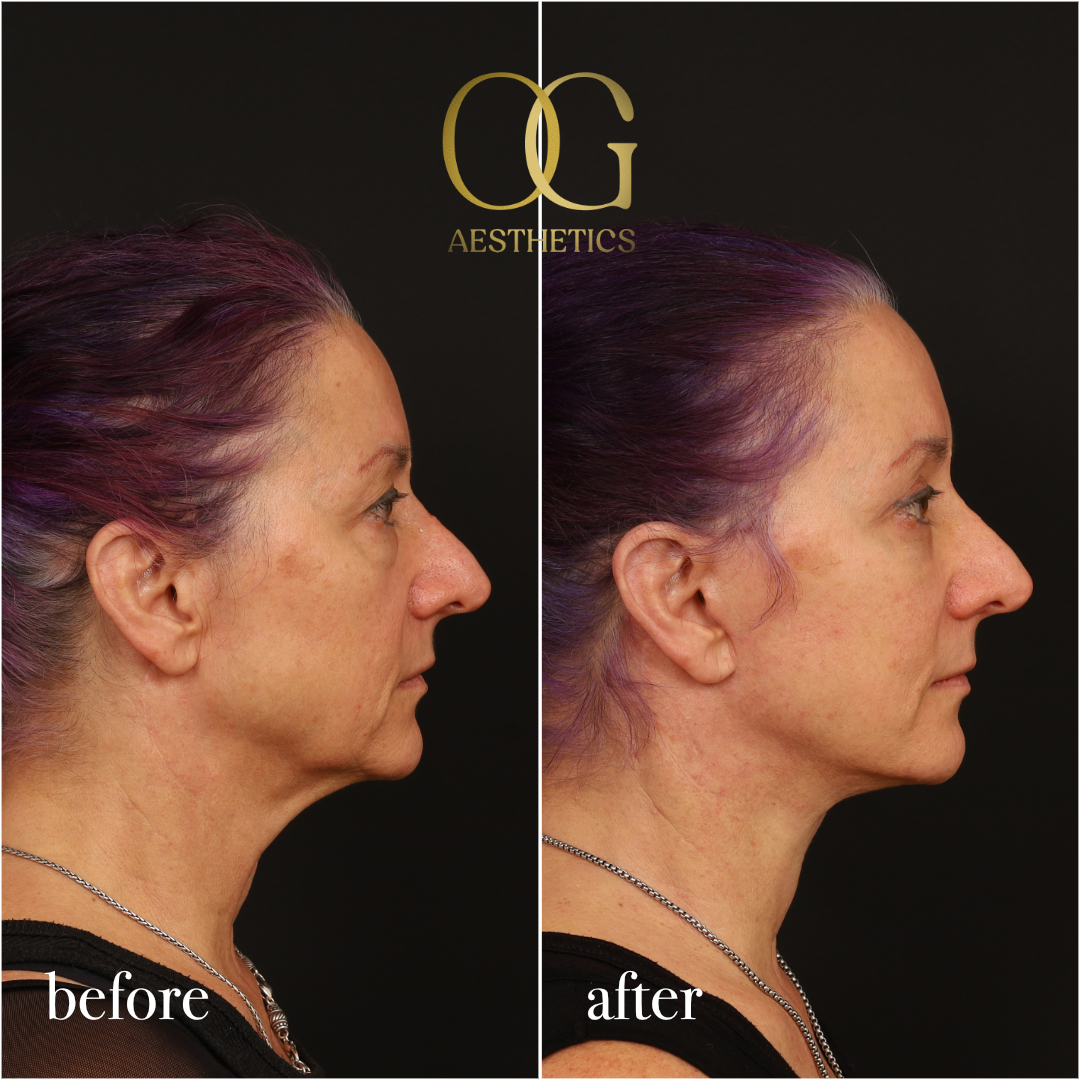 Blepharoplasty Before & After Gallery - Patient 926271 - Image 4