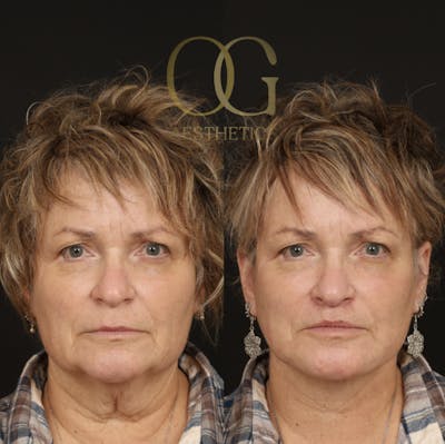Facelift Before & After Gallery - Patient 429152 - Image 1