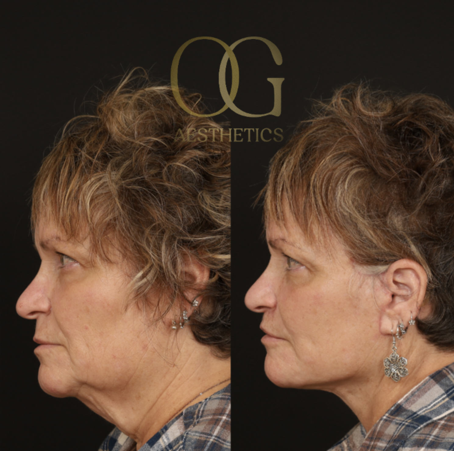 Facelift Before & After Gallery - Patient 429152 - Image 5