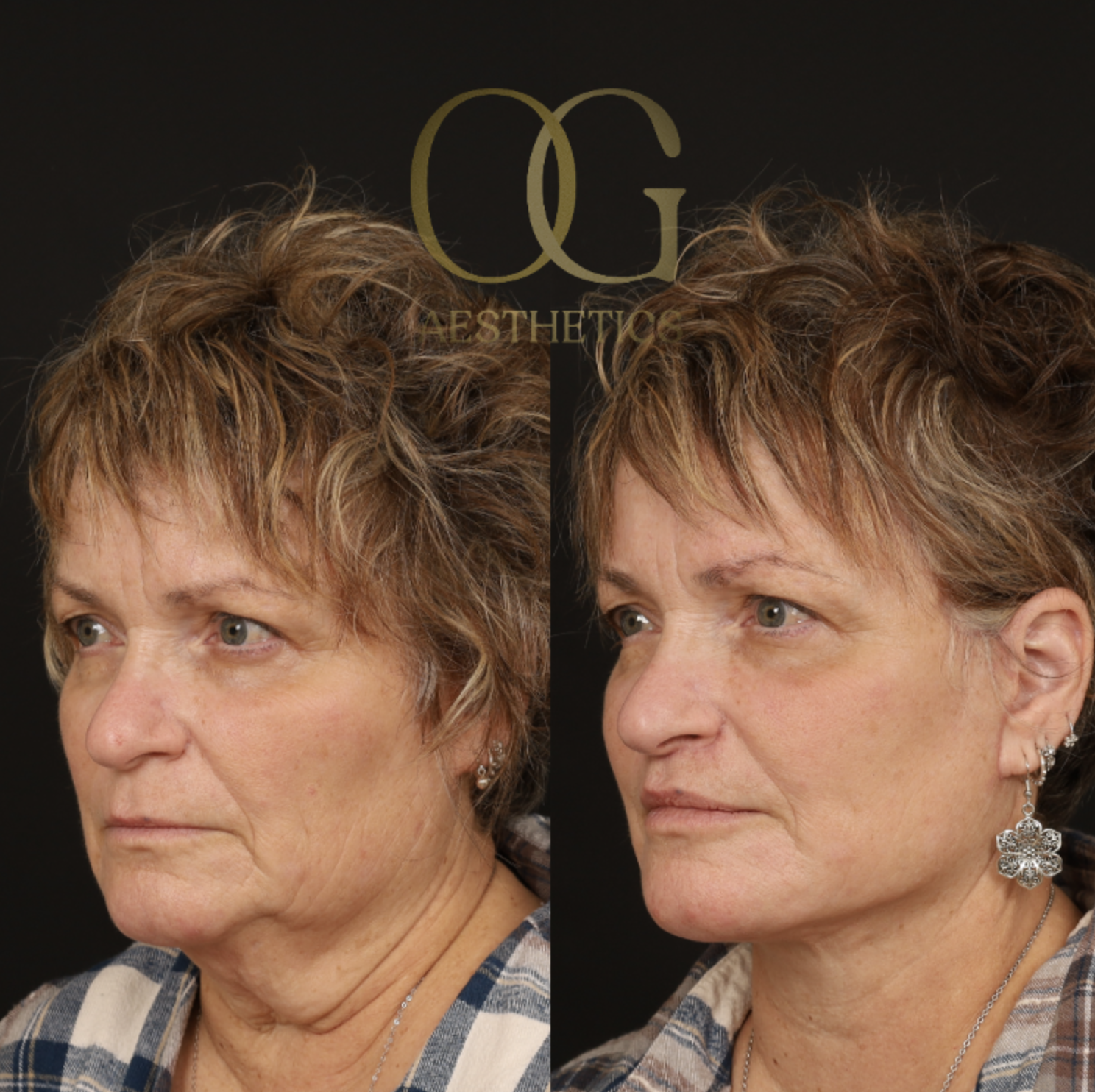 Facelift Before & After Gallery - Patient 429152 - Image 4