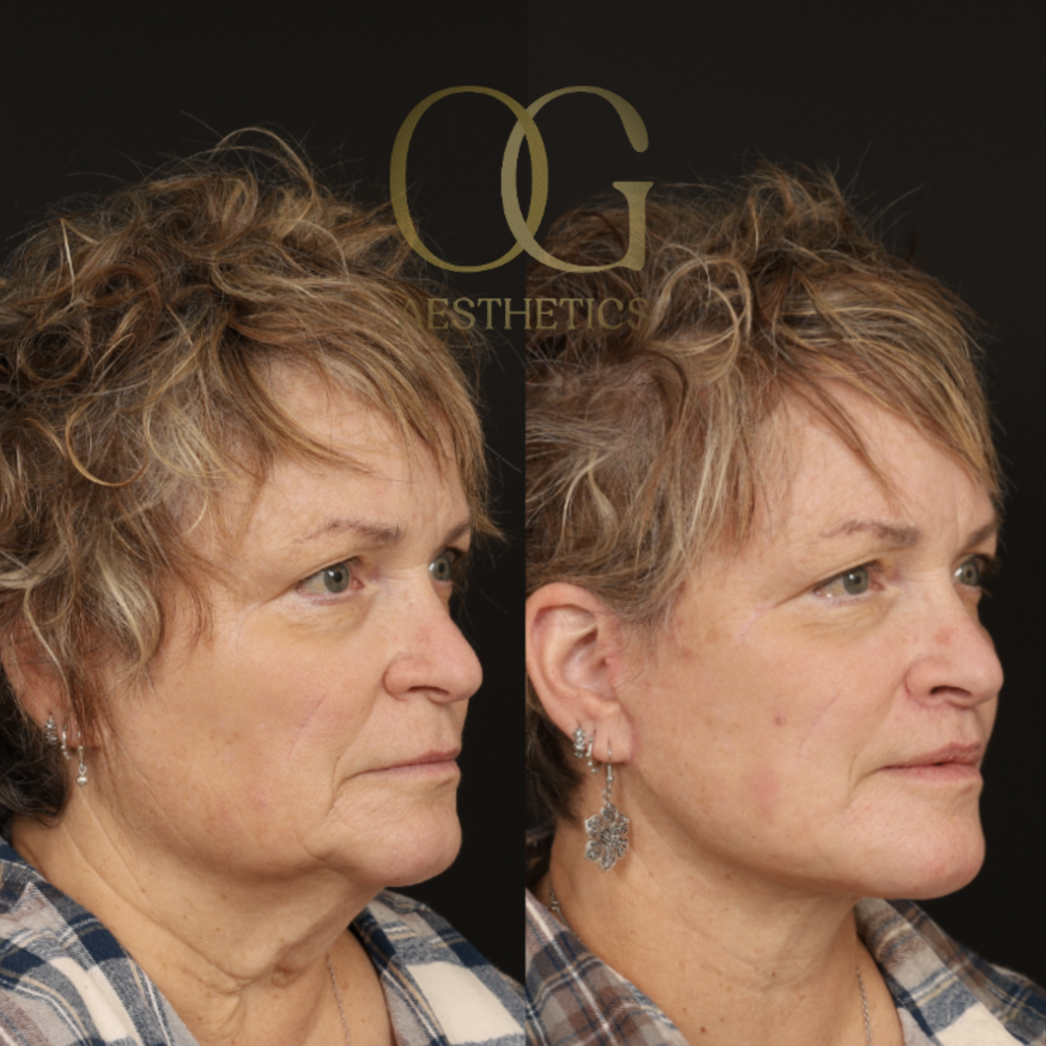 Facelift Before & After Gallery - Patient 429152 - Image 2