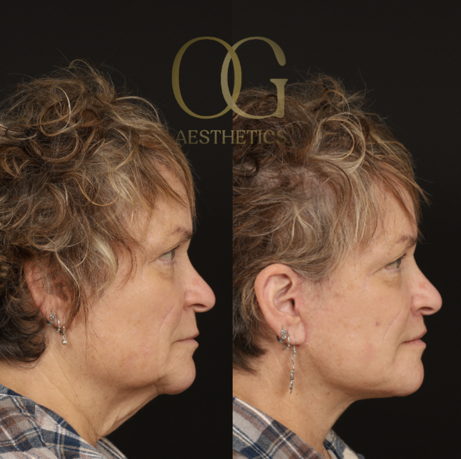 Facelift Before & After Gallery - Patient 429152 - Image 3
