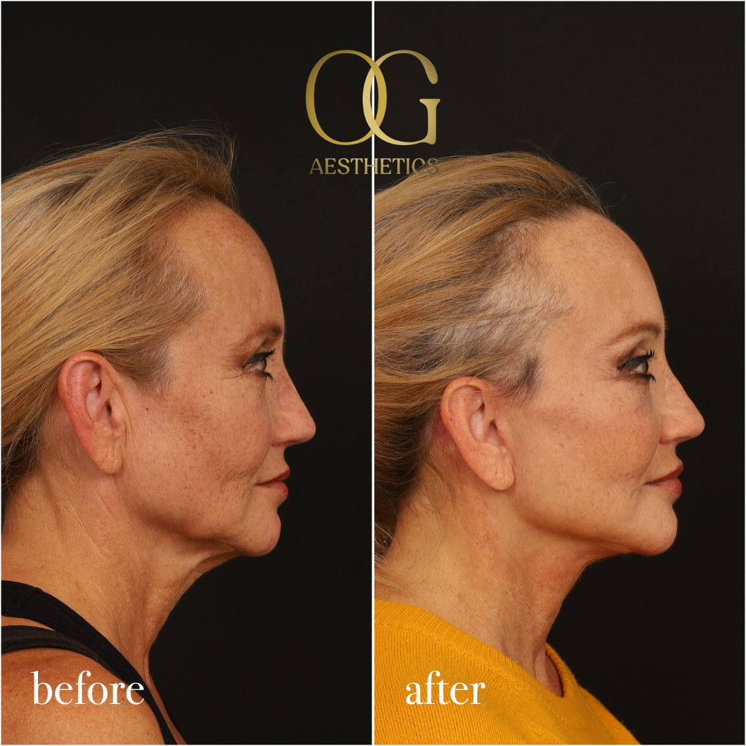 Facelift Before & After Gallery - Patient 277022 - Image 4