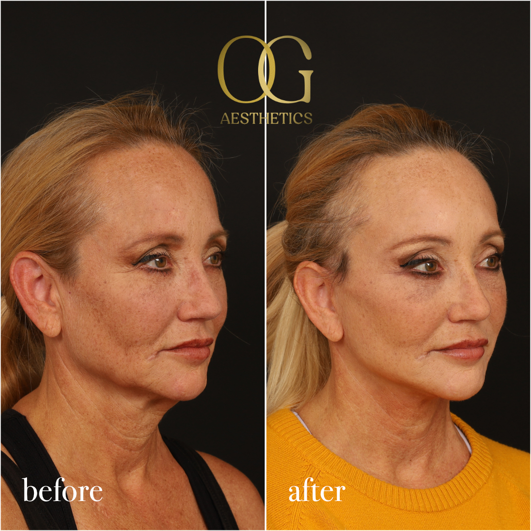Facelift Before & After Gallery - Patient 277022 - Image 3