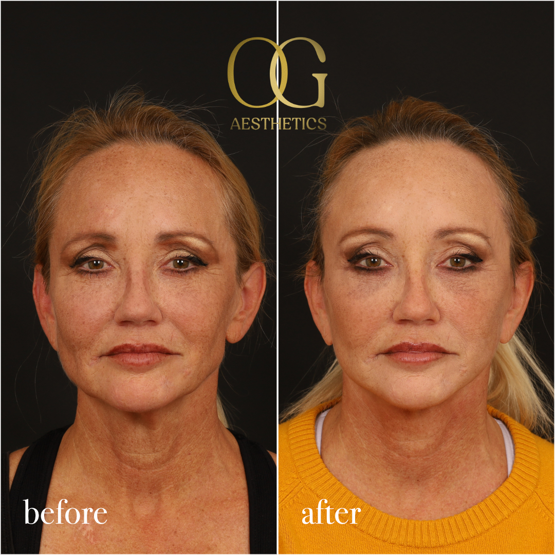 Facelift Before & After Gallery - Patient 277022 - Image 1