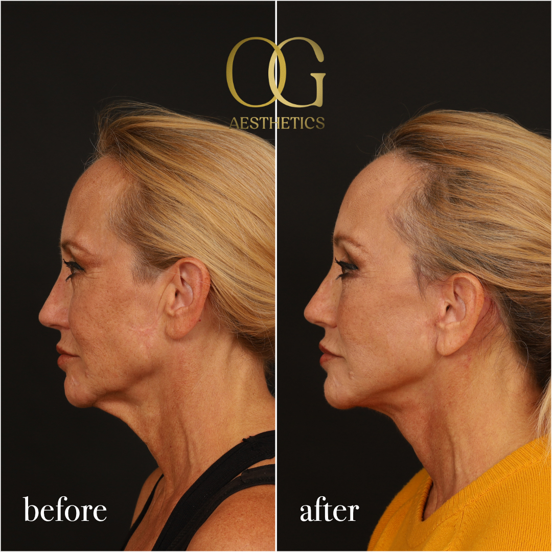 Facelift Before & After Gallery - Patient 277022 - Image 6