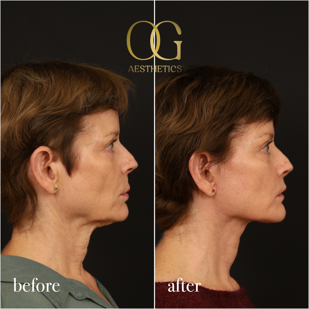 Lip Lift Before & After Gallery - Patient 528623 - Image 3