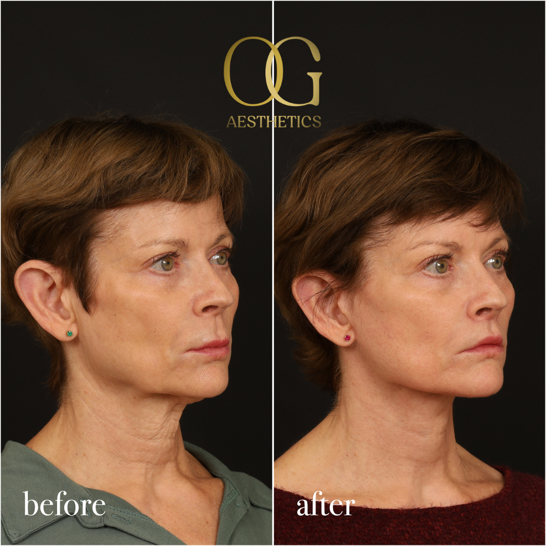 Lip Lift Before & After Gallery - Patient 528623 - Image 2