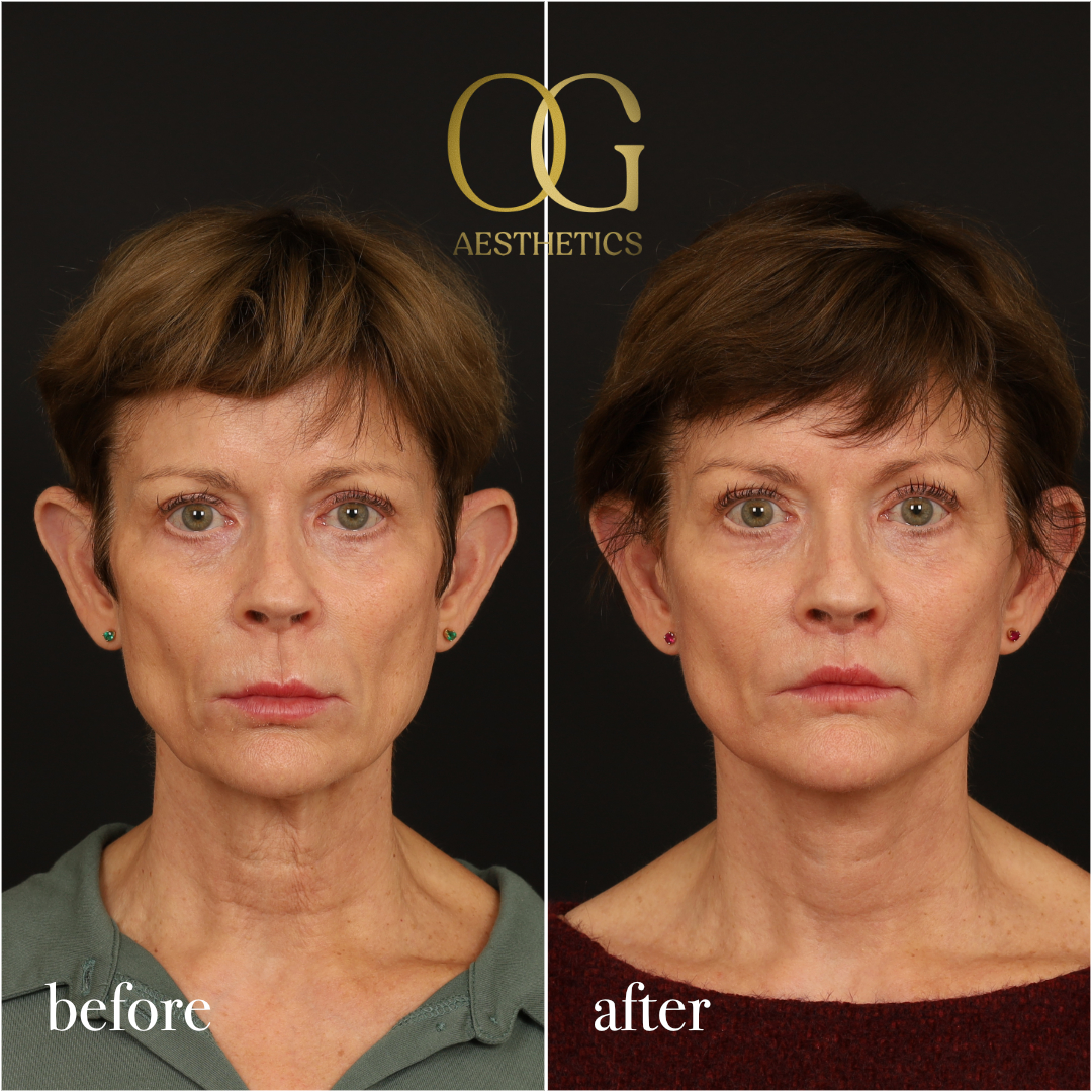 Lip Lift Before & After Gallery - Patient 528623 - Image 1