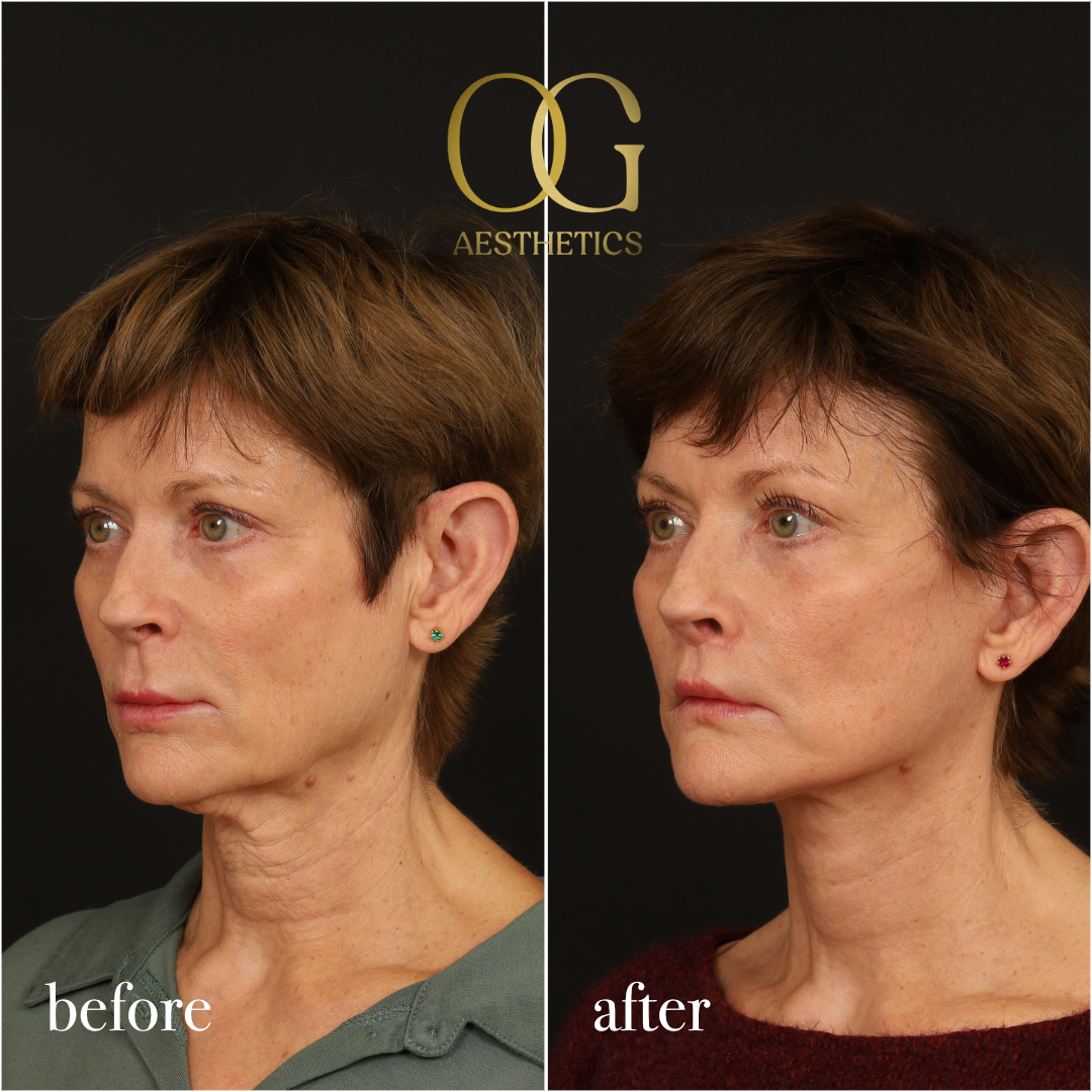Lip Lift Before & After Gallery - Patient 528623 - Image 4