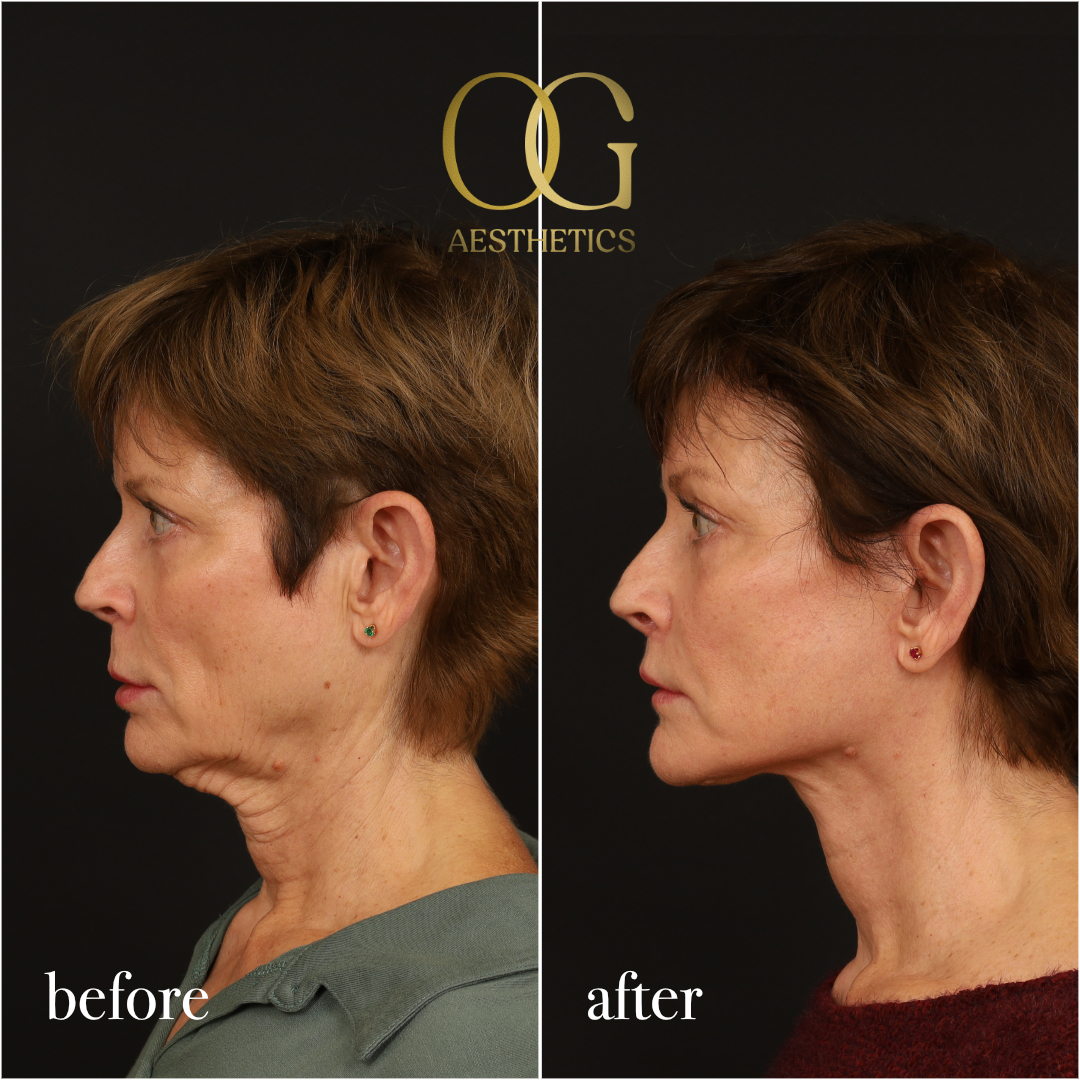 Lip Lift Before & After Gallery - Patient 528623 - Image 5