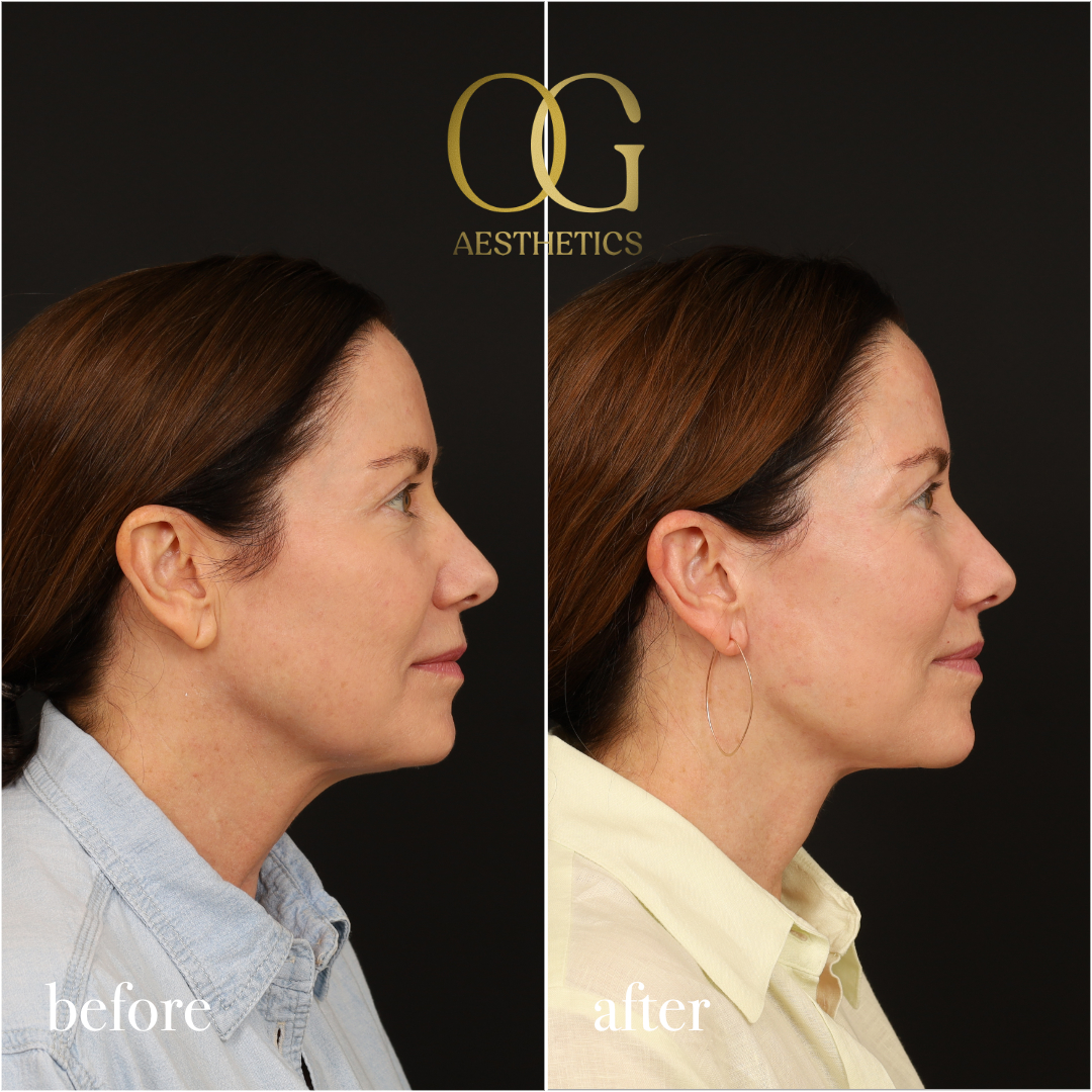 Neck Lift Before & After Gallery - Patient 174697 - Image 4