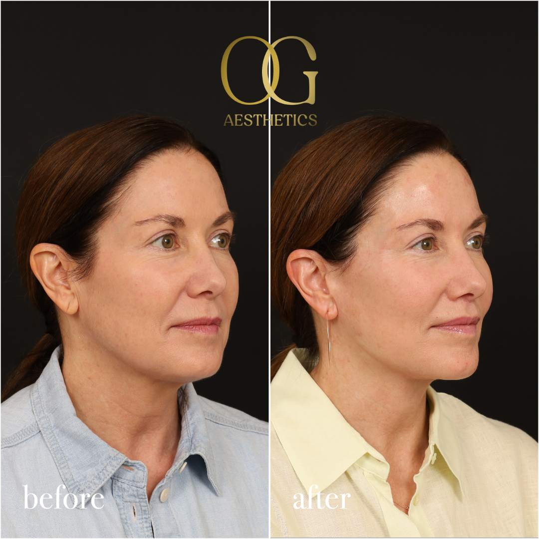Neck Lift Before & After Gallery - Patient 174697 - Image 3