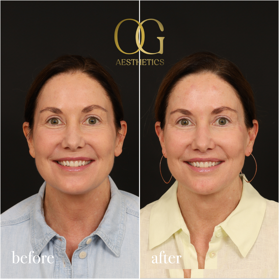 Neck Lift Before & After Gallery - Patient 174697 - Image 2