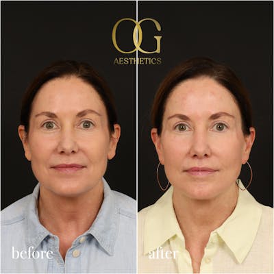 Lip Lift Before & After Gallery - Patient 355885 - Image 1