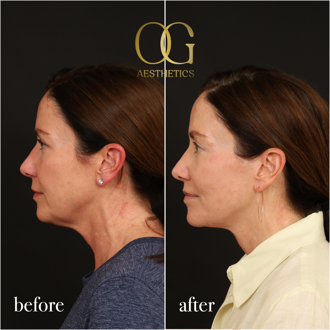Neck Lift Before & After Gallery - Patient 174697 - Image 6