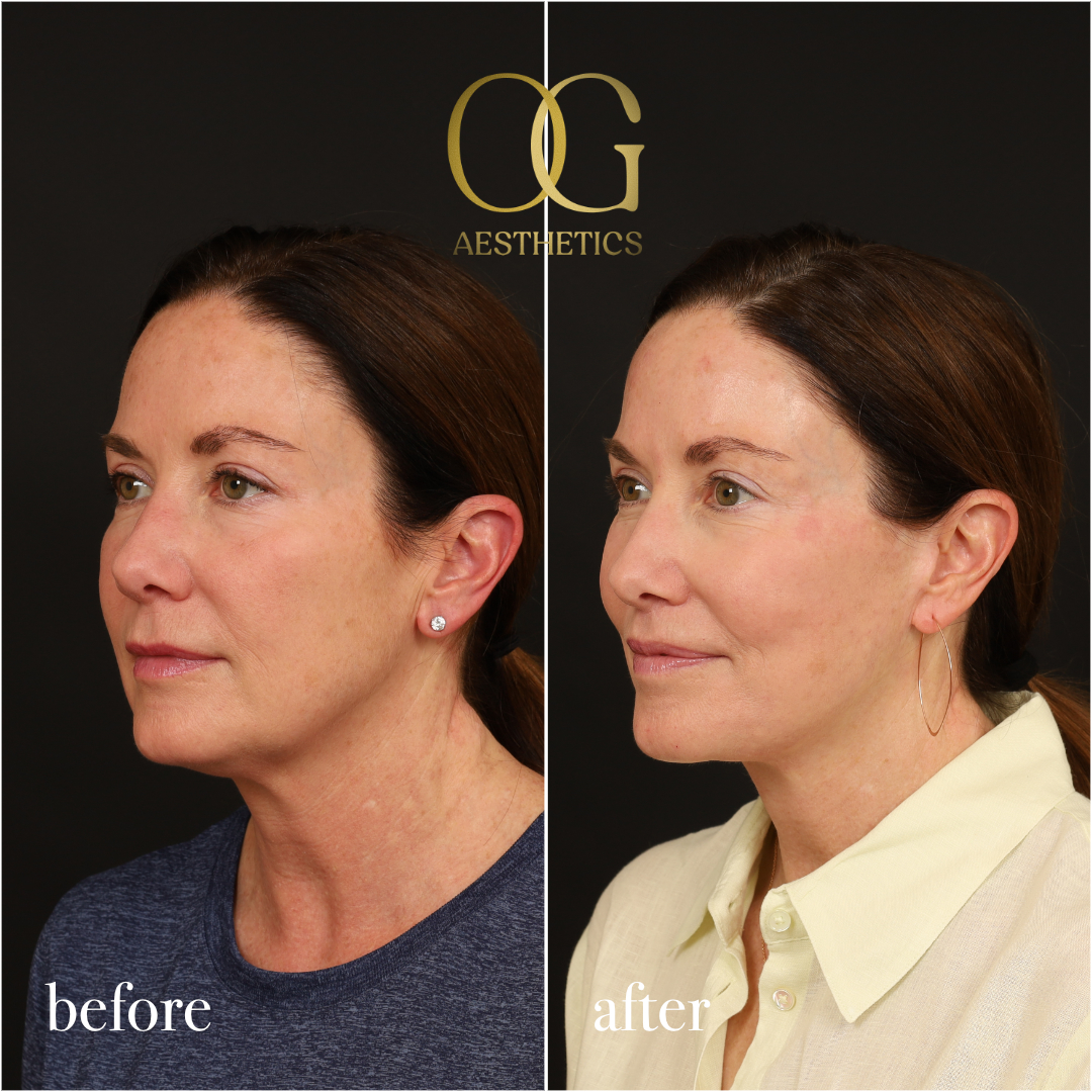 Neck Lift Before & After Gallery - Patient 174697 - Image 5