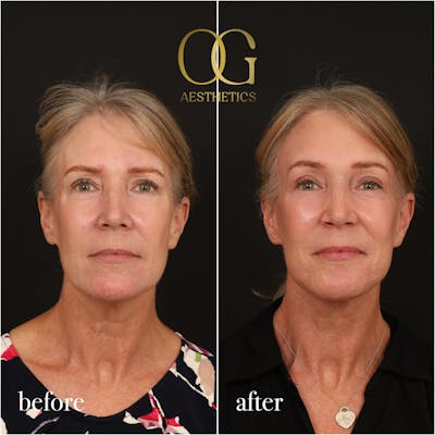 Brow Lift Before & After Gallery - Patient 302259 - Image 1