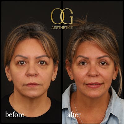 Blepharoplasty Before & After Gallery - Patient 313344 - Image 1