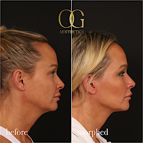 Neck Lift Before & After Gallery - Patient 273065 - Image 8