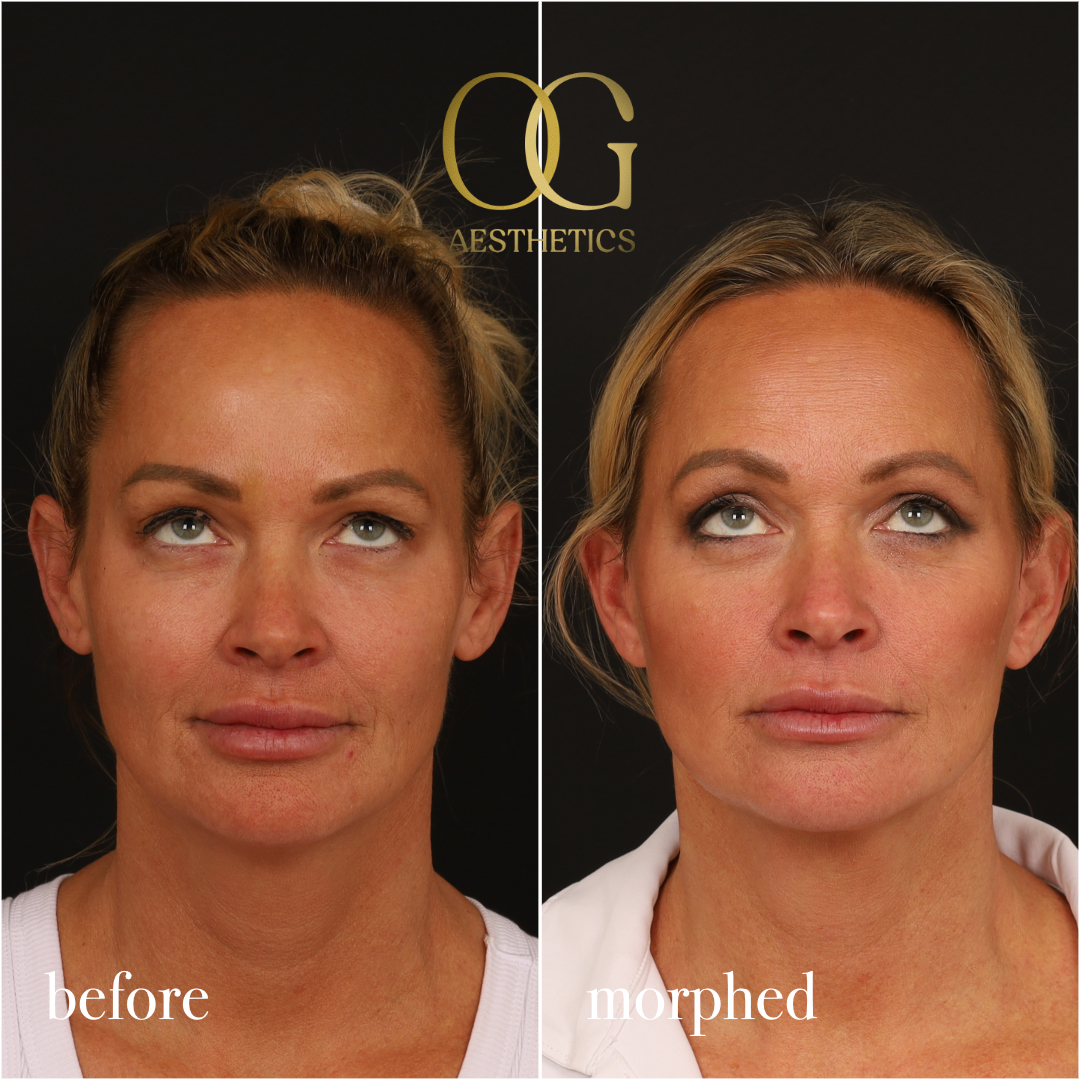 Neck Lift Before & After Gallery - Patient 273065 - Image 1