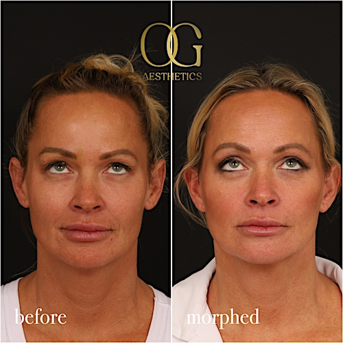 Neck Lift Before & After Gallery - Patient 273065 - Image 1