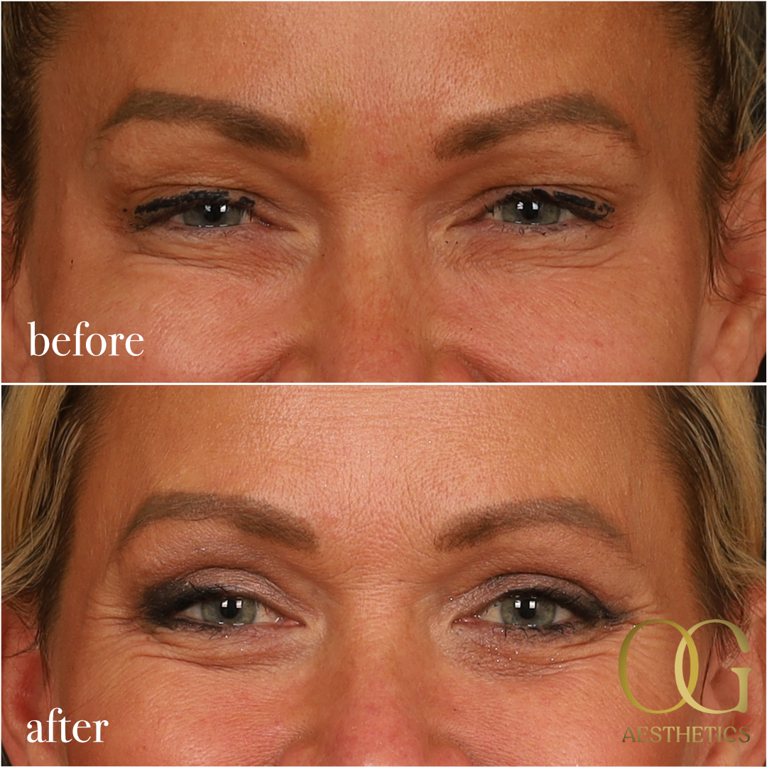 Blepharoplasty Before & After Gallery - Patient 242962 - Image 10