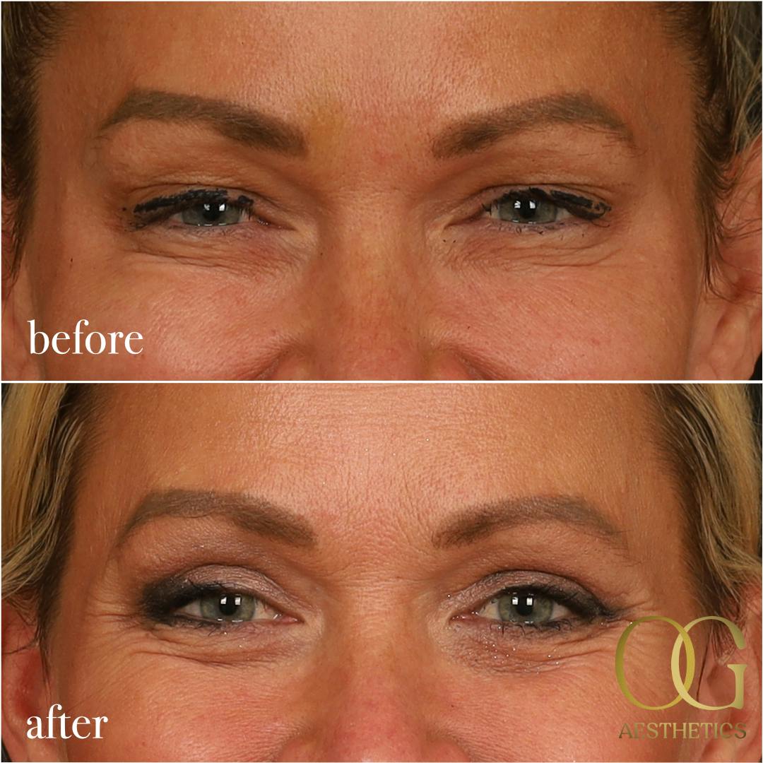 Blepharoplasty Before & After Gallery - Patient 242962 - Image 10